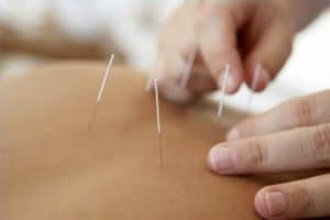 Acupuncture Weight Loss Review