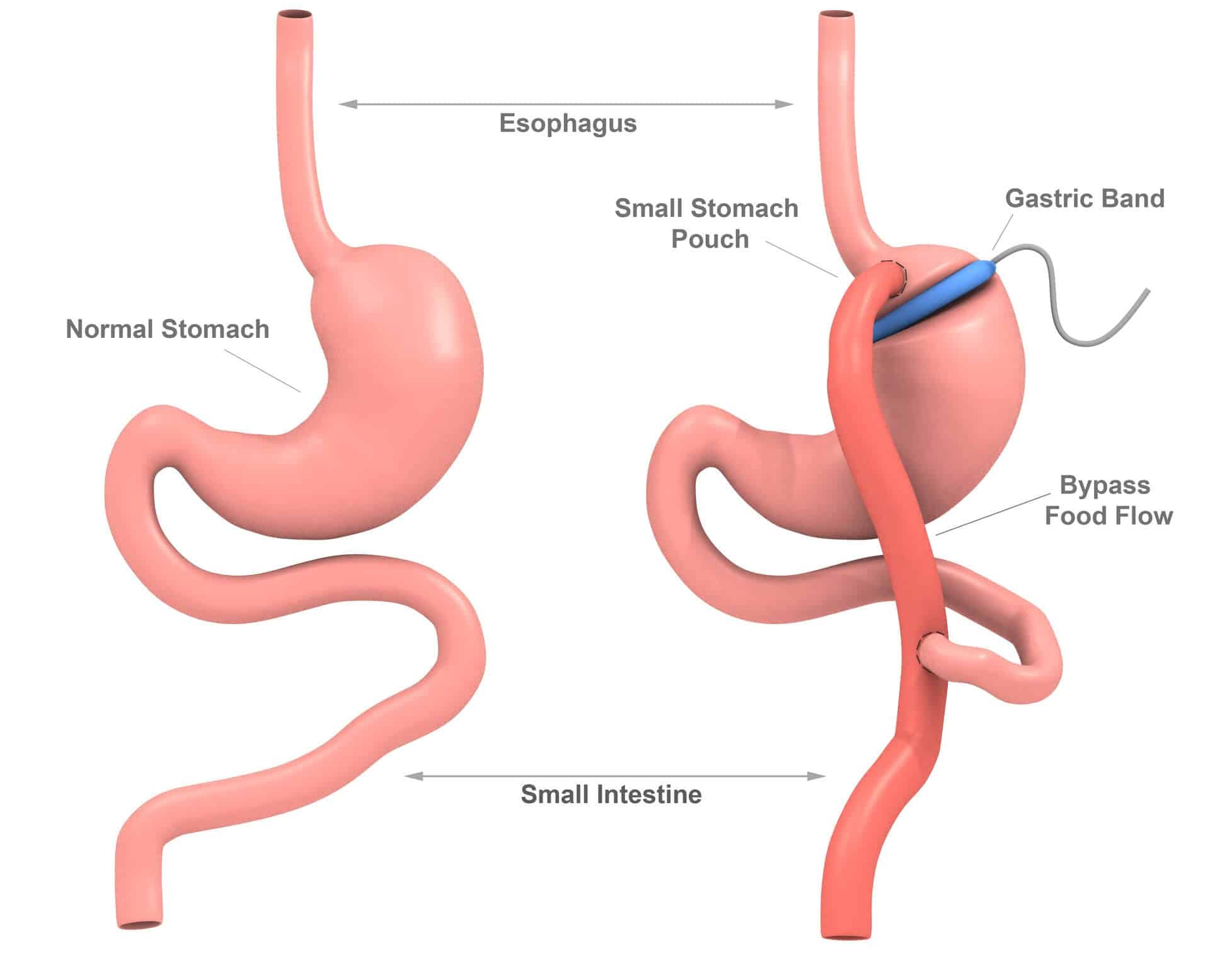 Weight Loss Procedures What Are Weight Loss Surgery Requirements 