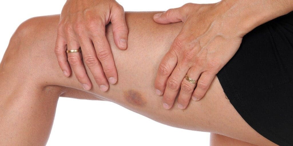 hands holding left leg showing bruise on the lower left part