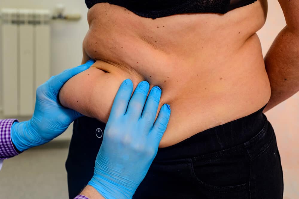 doctor grabbing stomach fat of patient